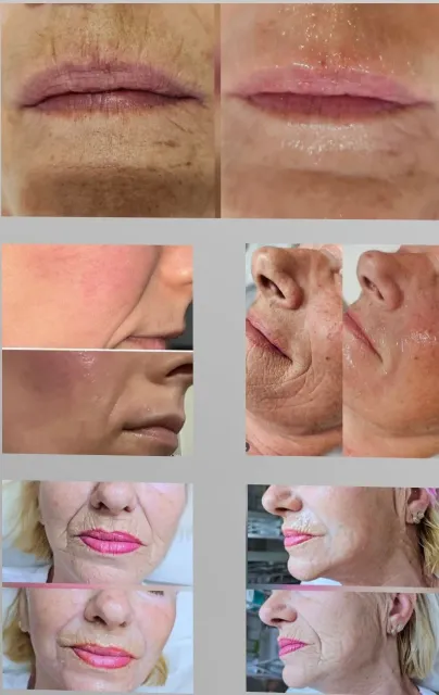 kolagen niti sa dermapen u salonu Studio Venera LM