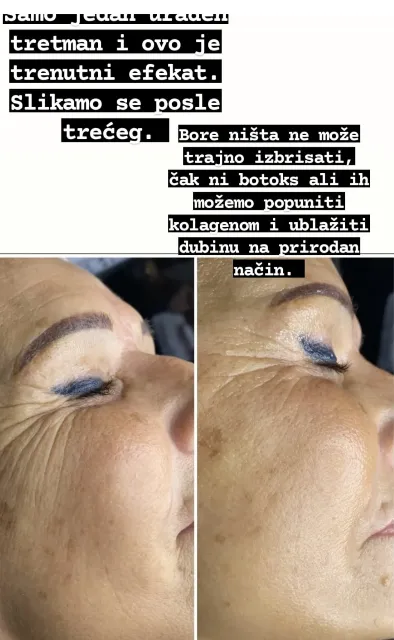 botox puder bez igle sa dermapen protiv bora, u salonu Studio Venera LM